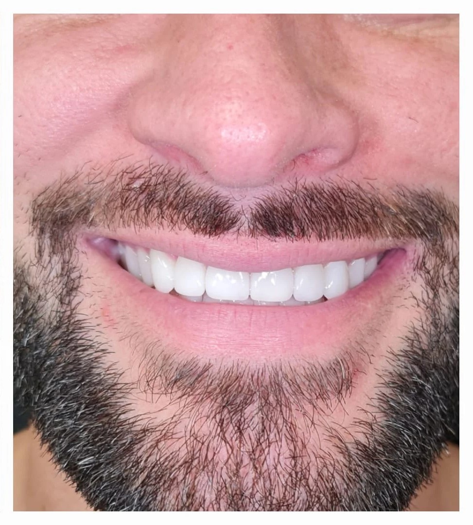 Dental Crowns after treatment results - Viva Dentistry Hurstville success case