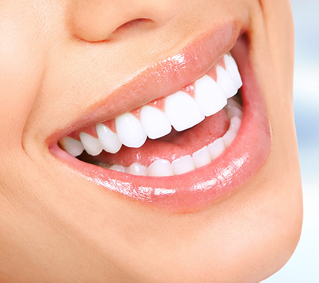 Dental Veneers after treatment results - Viva Dentistry Hurstville success case