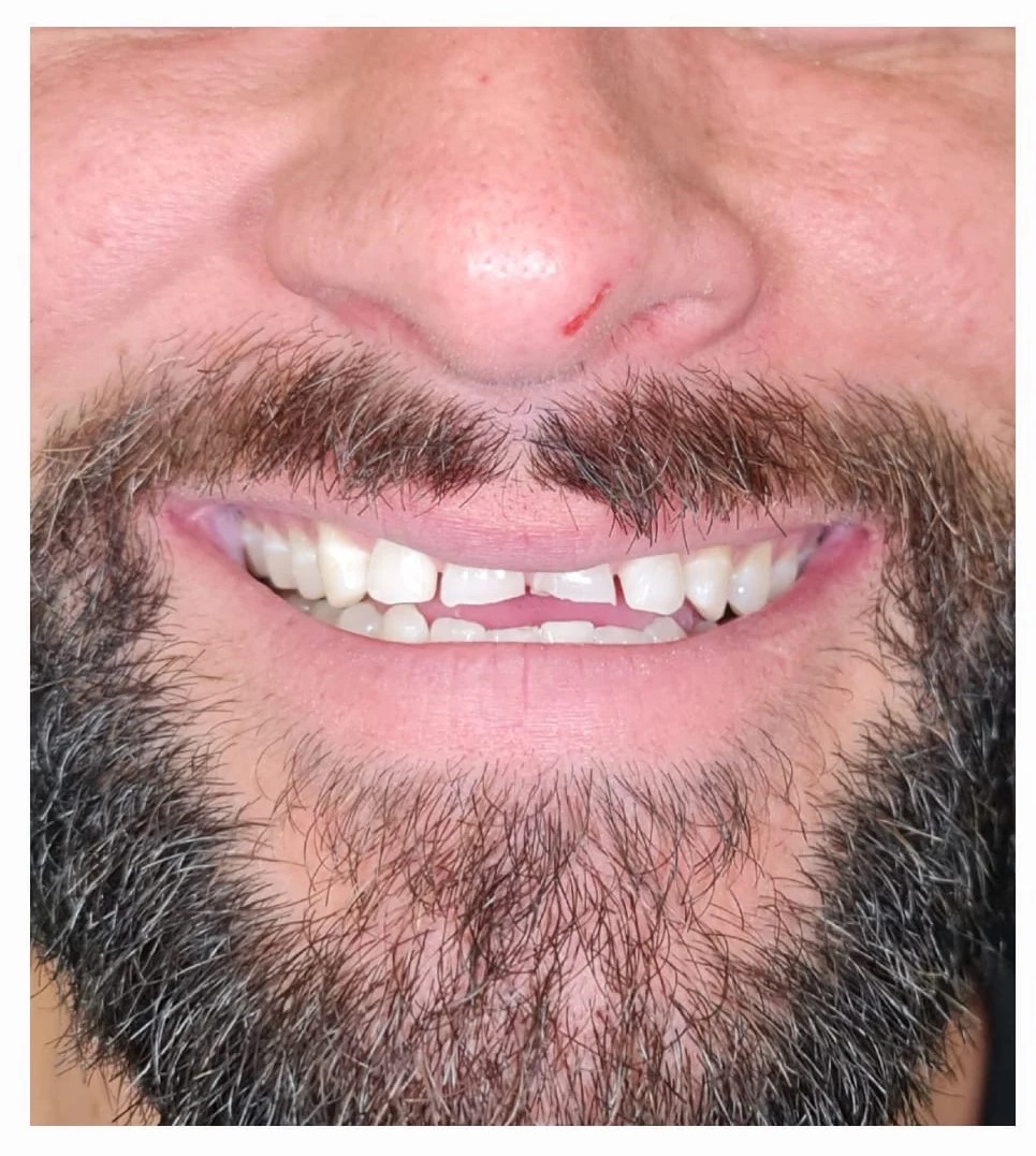 Dental Crowns before treatment - Hurstville dental patient case by Dr. Amin Yeganeh