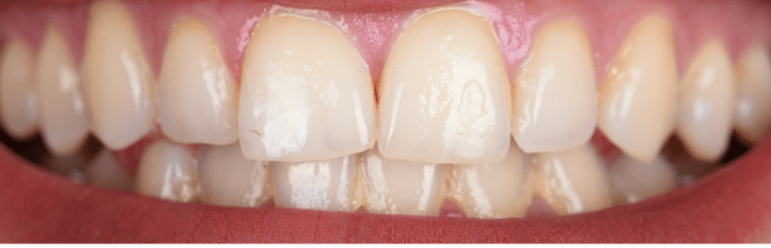 Teeth Whitening before treatment - Hurstville dental patient case by Dr. Amin Yeganeh